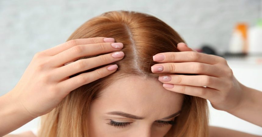 Cómo controlar la caspa y la caída del cabello
